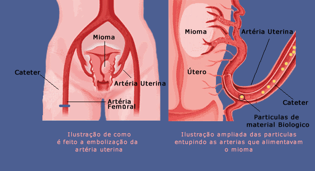 embolização de miomas uterinos